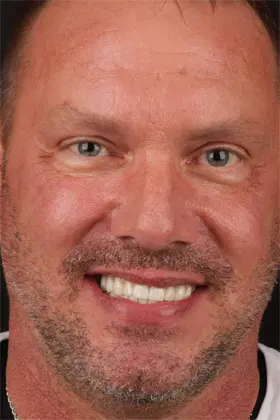 Patient showing off a perfect smile after cosmetic gum recontouring and veneers.